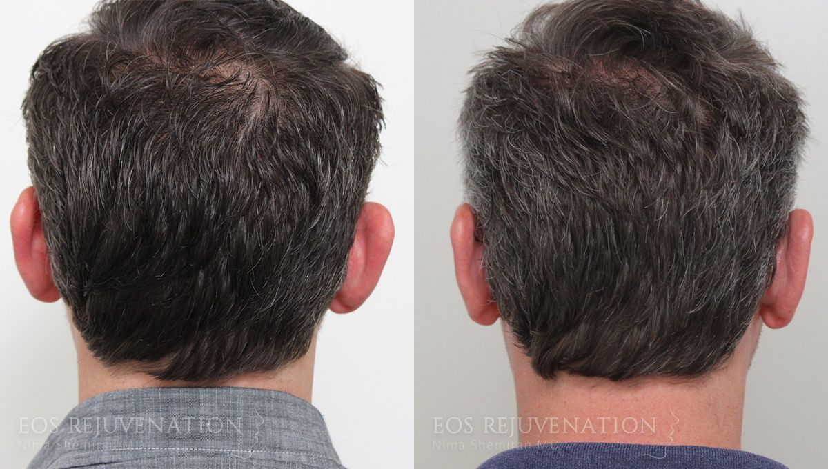 Otoplasty Before & After