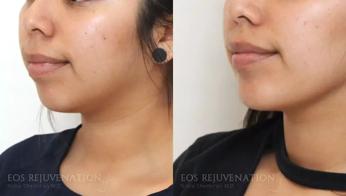 Neck Jawline Liposuction Before & After