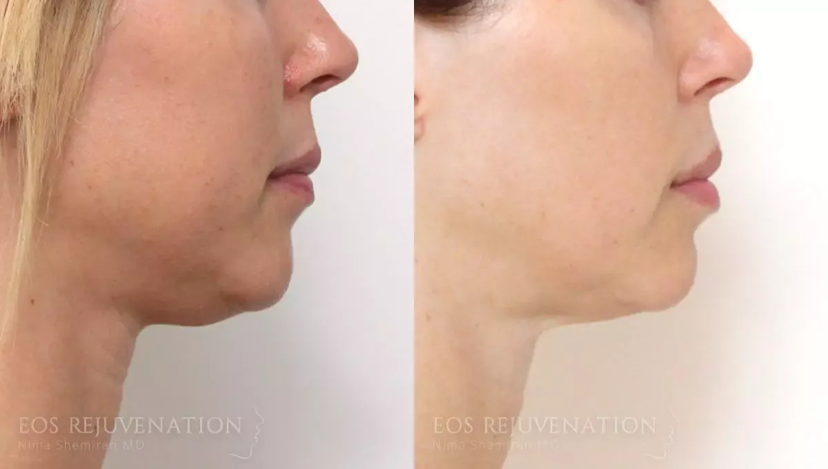 Neck Jawline Liposuction Before & After