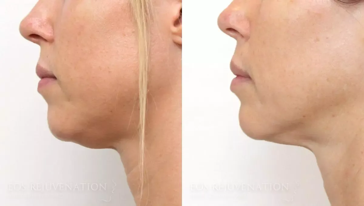 Neck Jawline Liposuction Before & After