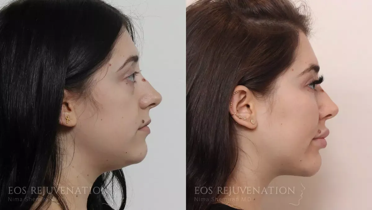Neck Jawline Liposuction Before & After