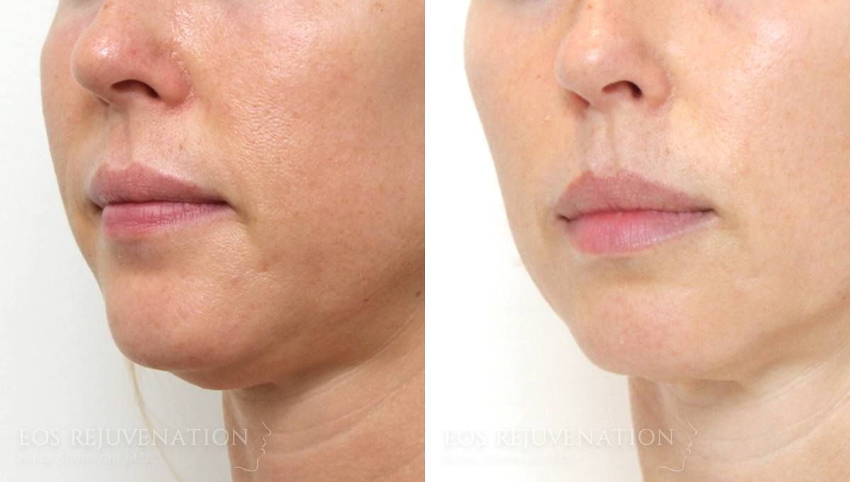 Fillers Before & After