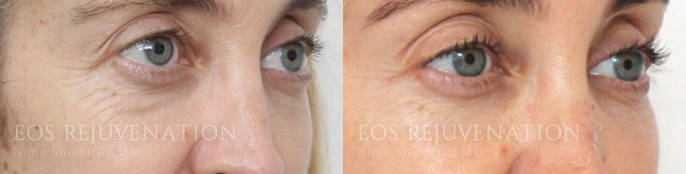 Fillers Before & After