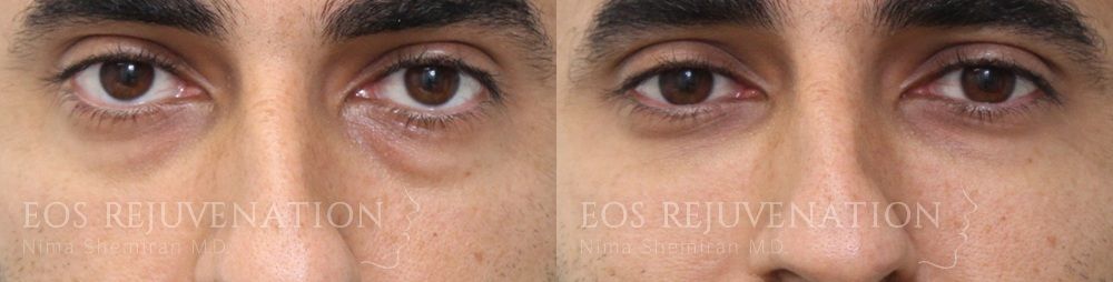 Fillers Before & After