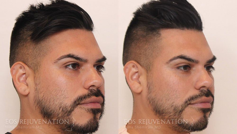 Fillers Before & After