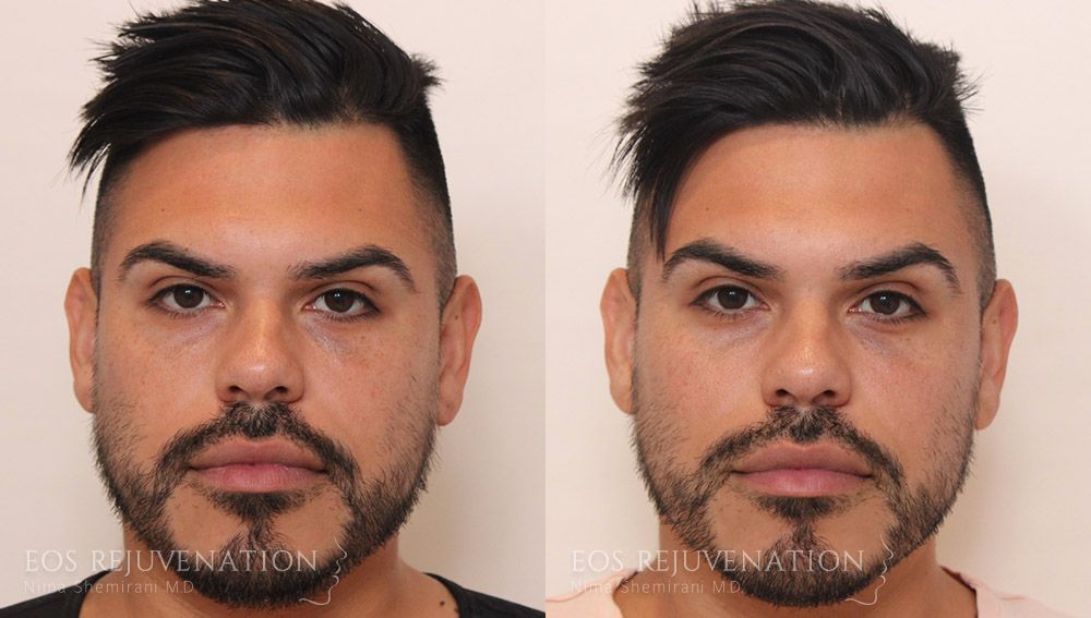 Fillers Before & After
