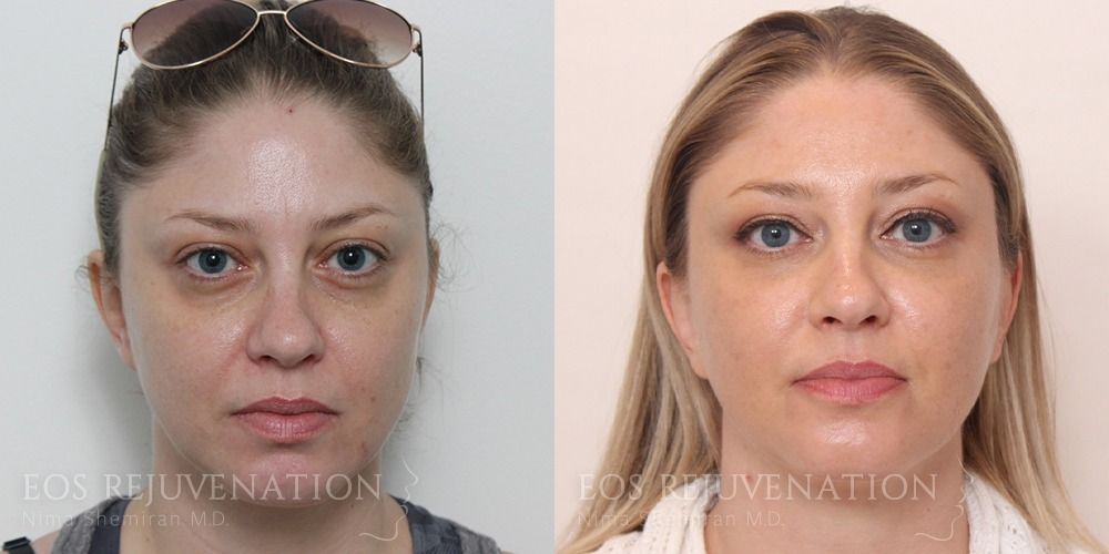 Fillers Before & After