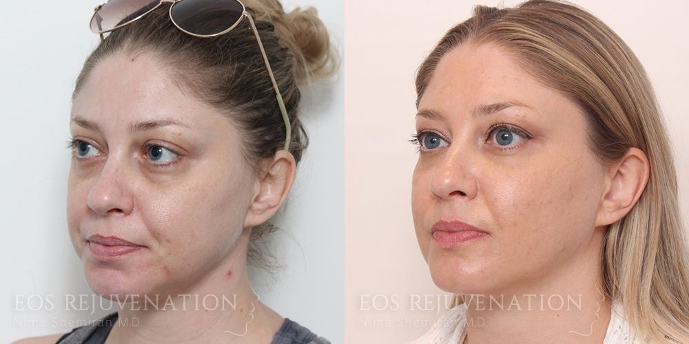 Fillers Before & After