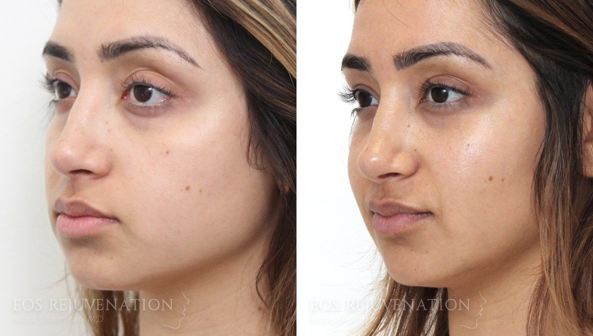 Fillers Before & After