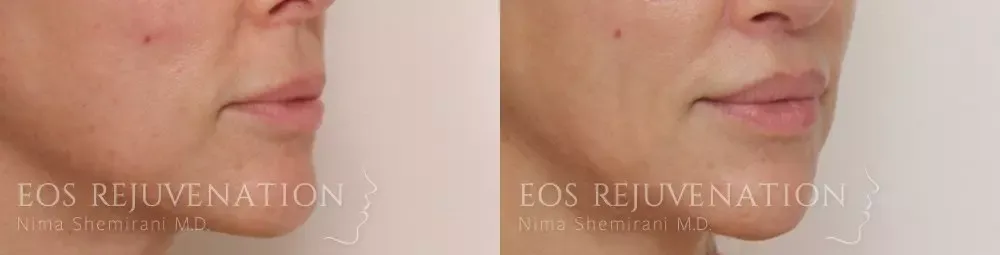 Lip Lift Before & After