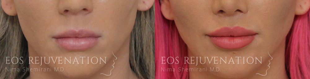 Lip Lift Before & After