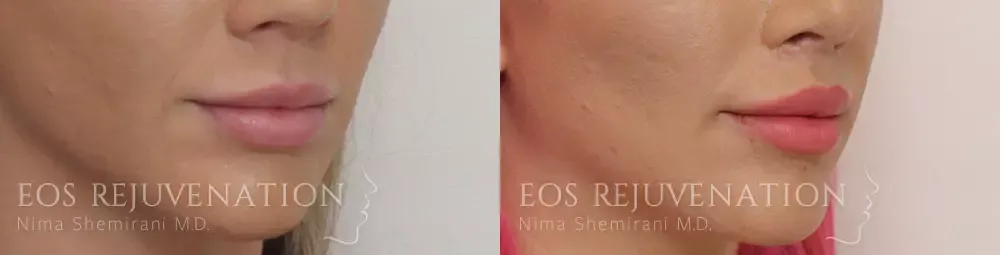 Lip Lift Before & After
