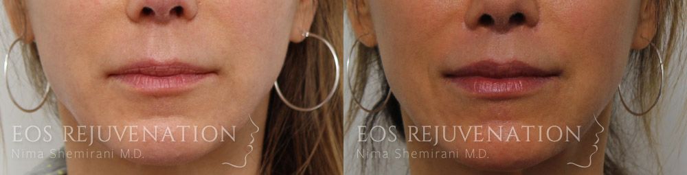 Lip Lift Before & After
