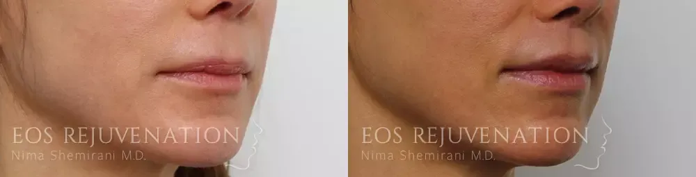 Lip Lift Before & After