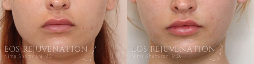 Lip Lift Before & After