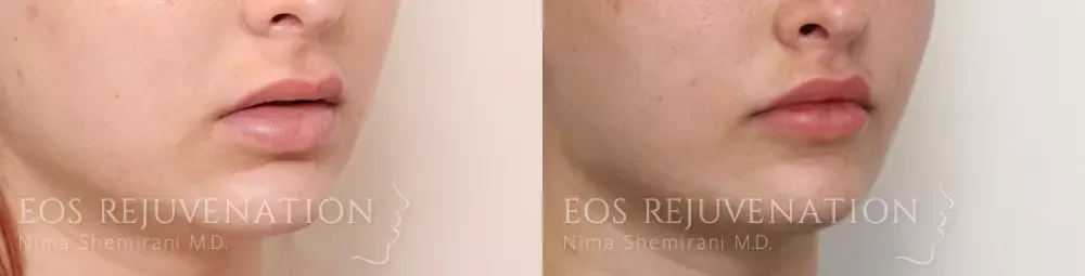 Lip Lift Before & After