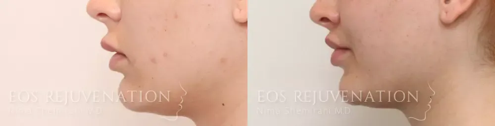 Lip Lift Before & After