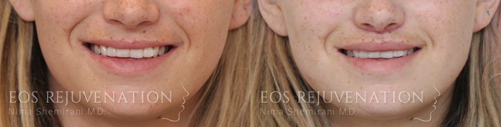 Lip Lift Before & After