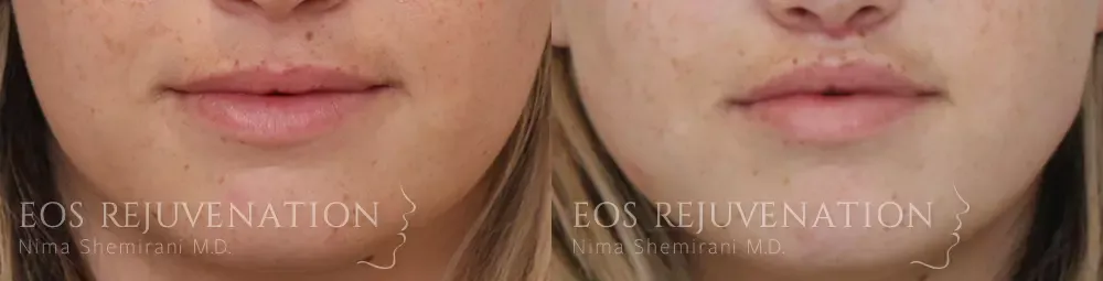 Lip Lift Before & After