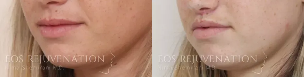Lip Lift Before & After