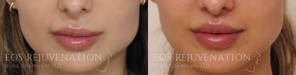 Lip Lift Before & After