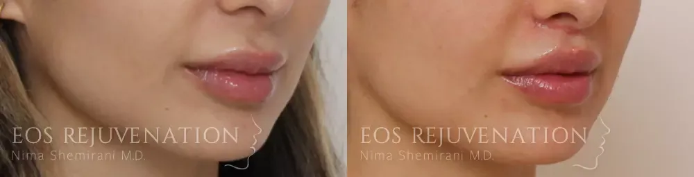 Lip Lift Before & After