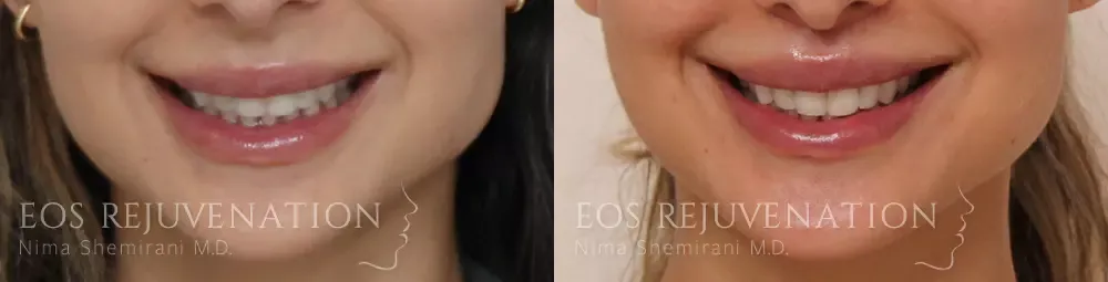 Lip Lift Before & After