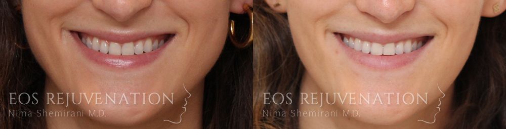 Lip Lift Before & After