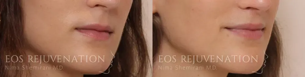 Lip Lift Before & After
