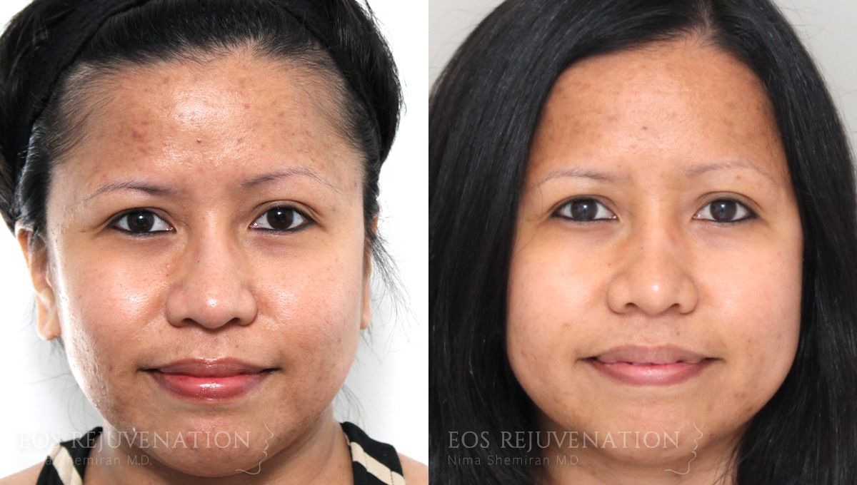 Microneedling Before & After