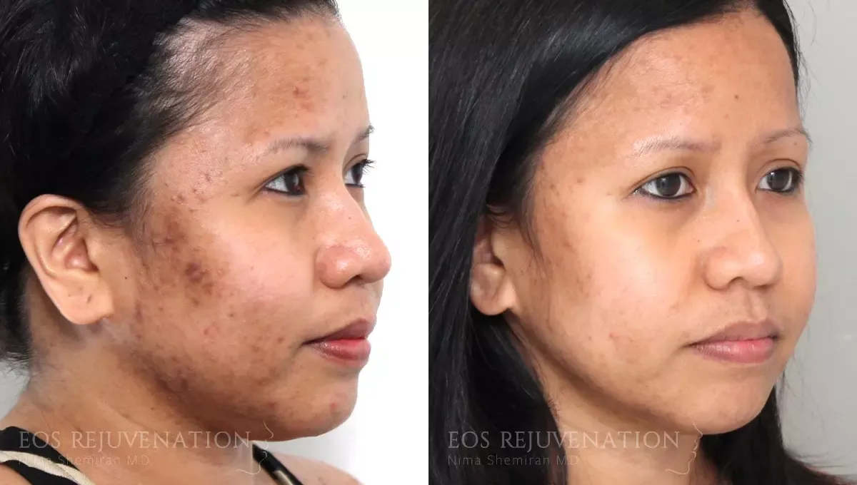 Microneedling Before & After