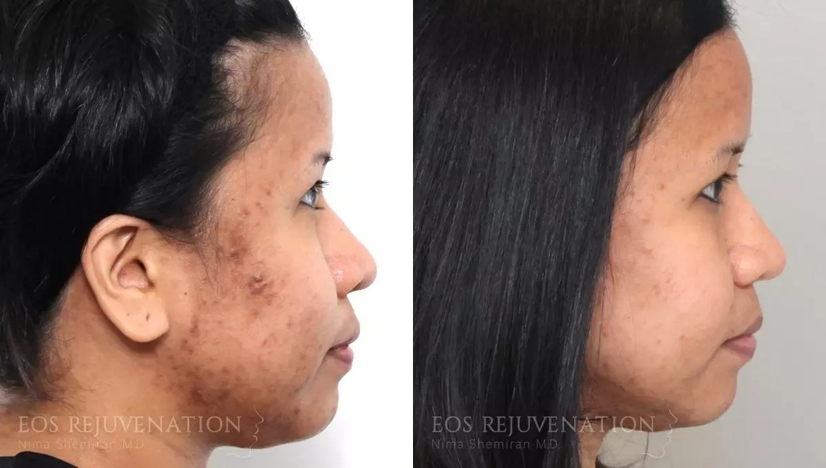 Microneedling Before & After