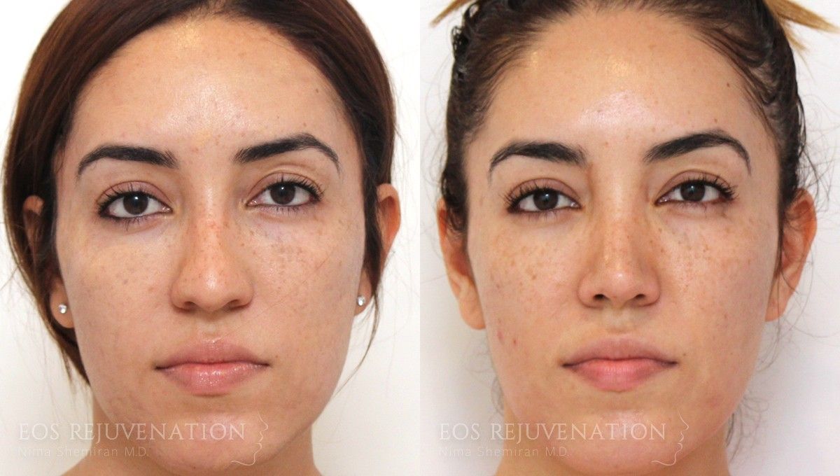 Microneedling Before & After