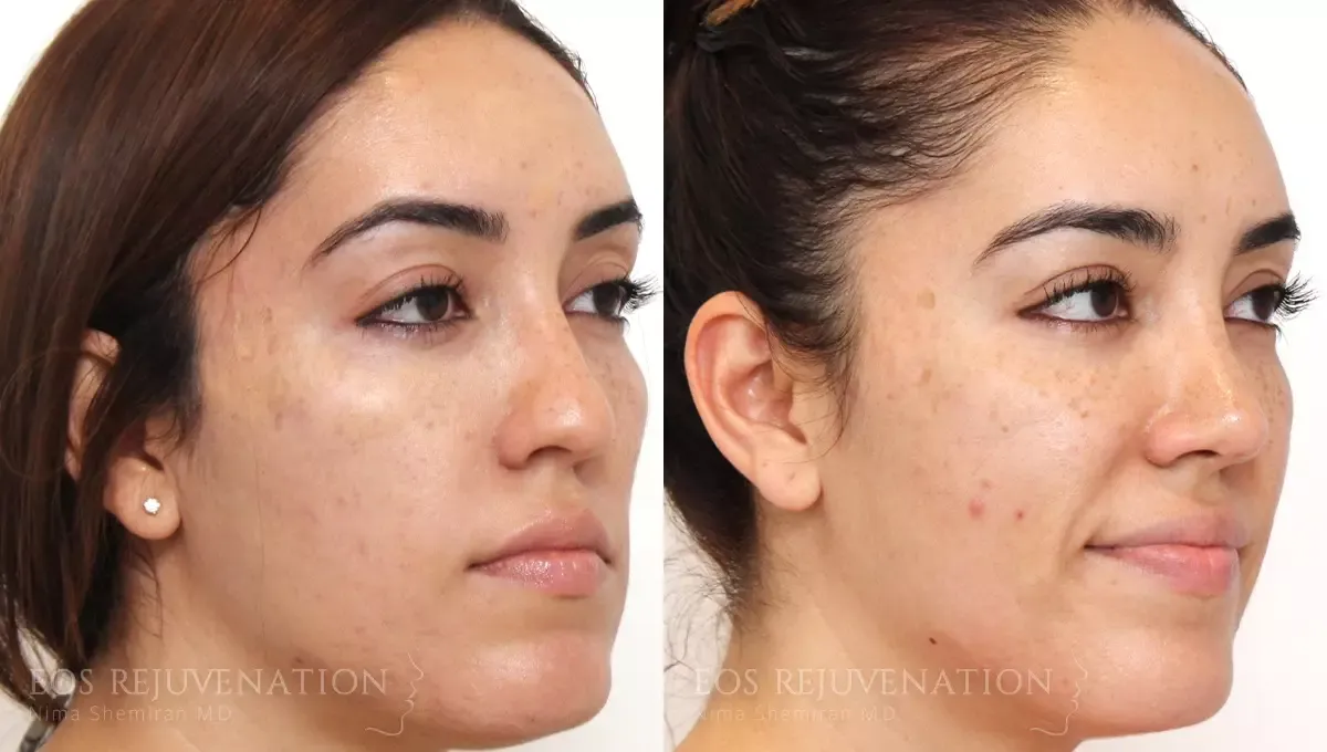 Microneedling Before & After