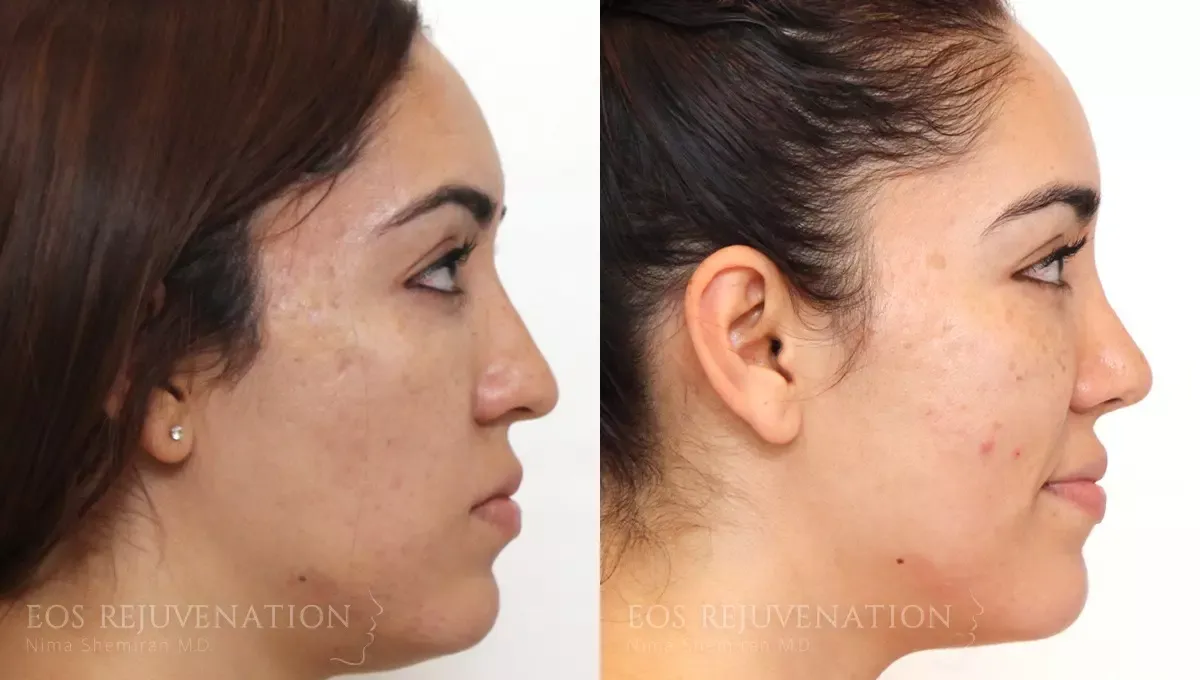 Microneedling Before & After