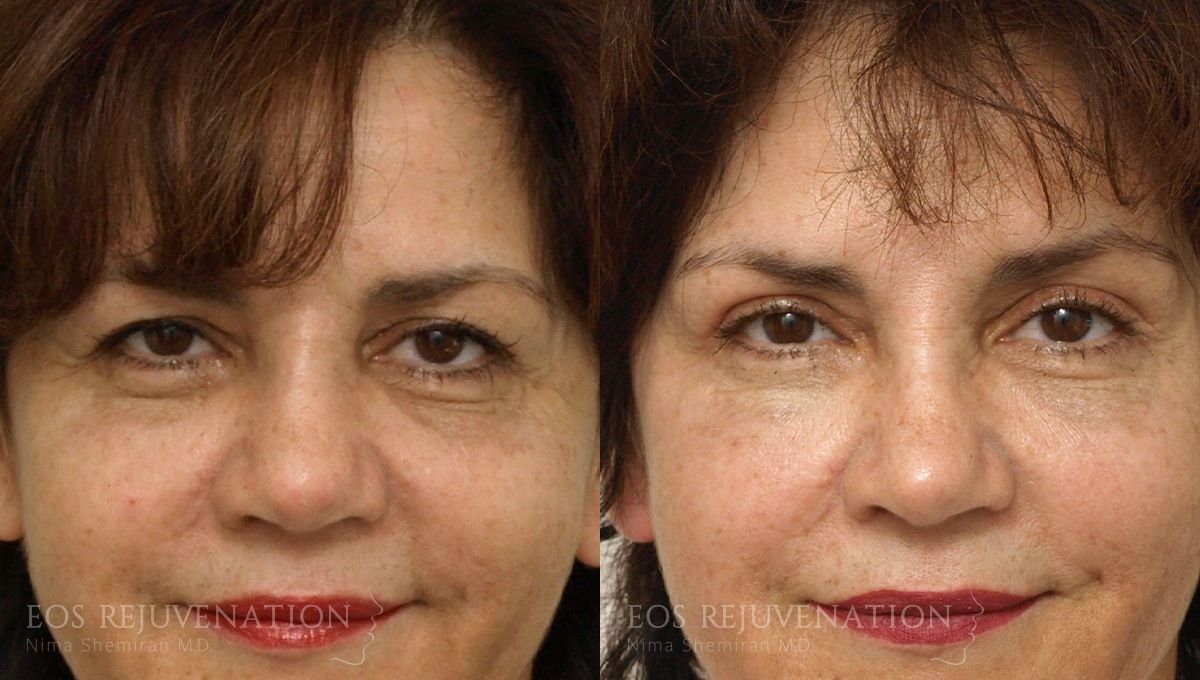 Brow Lift Before & After
