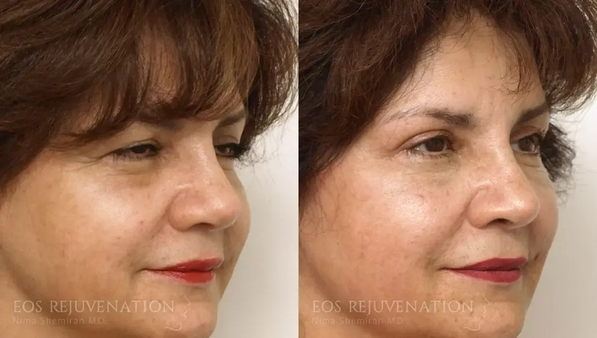 Brow Lift Before & After