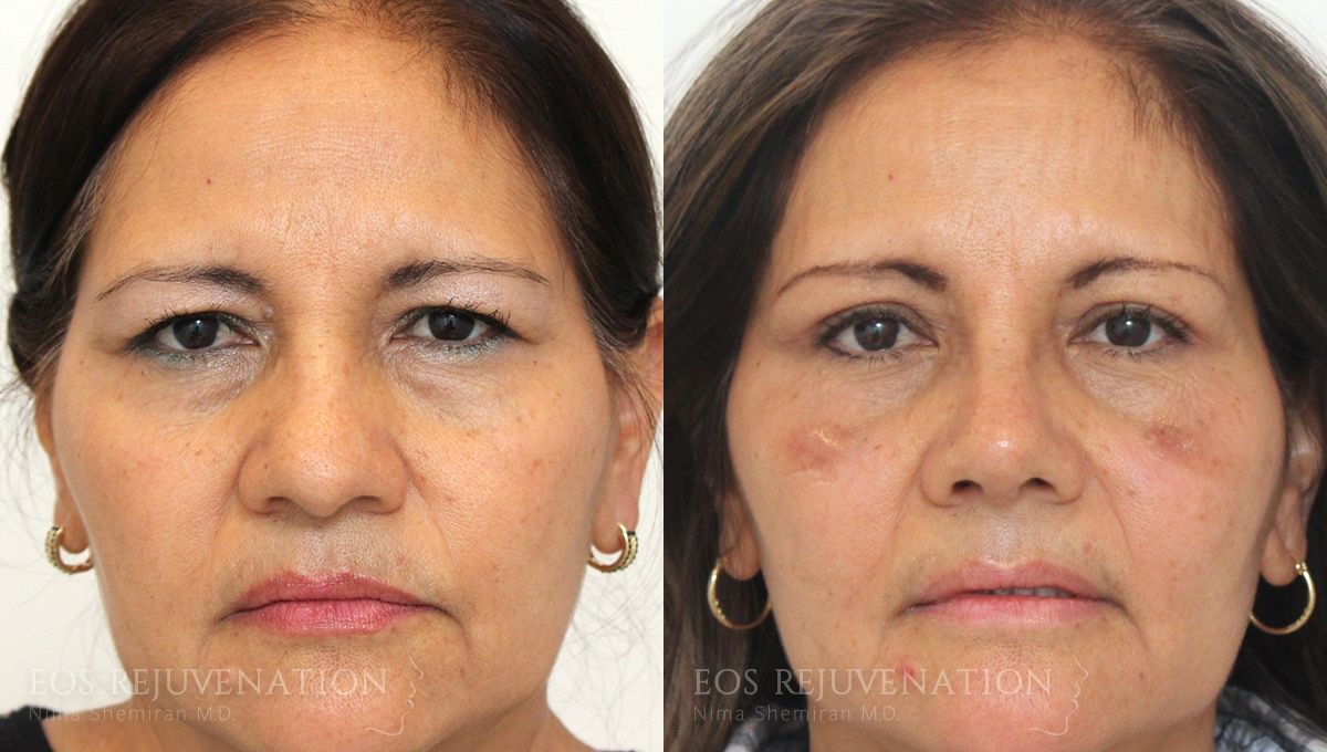 Brow Lift Before & After