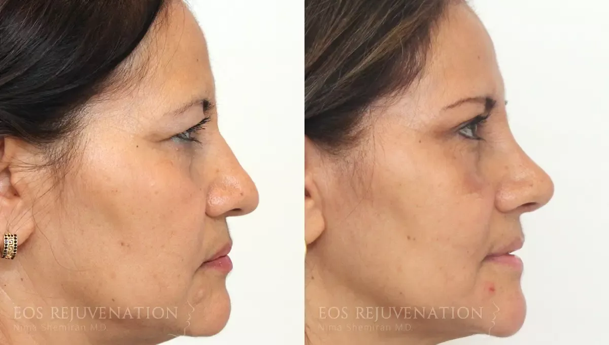 Brow Lift Before & After