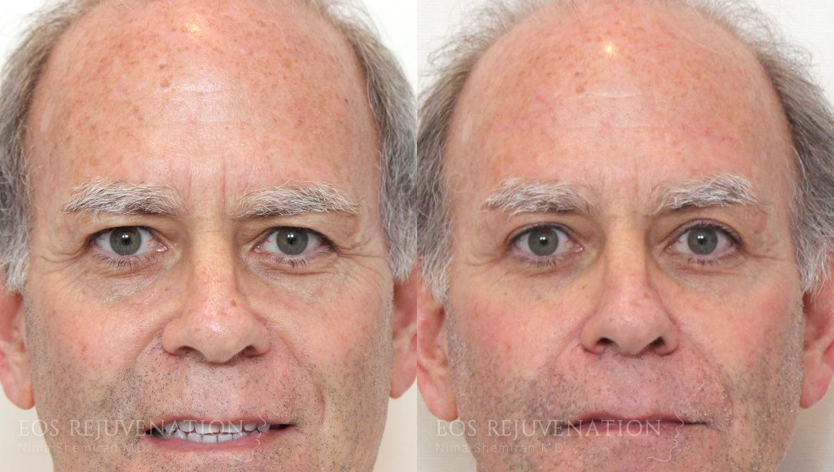 Brow Lift Before & After