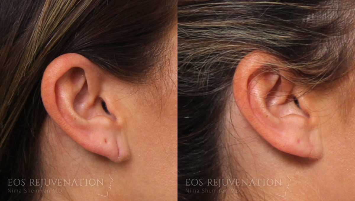 Earlobe Repair Before & After