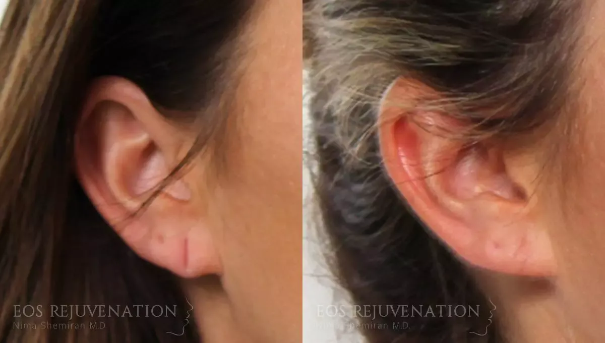Earlobe Repair Before & After