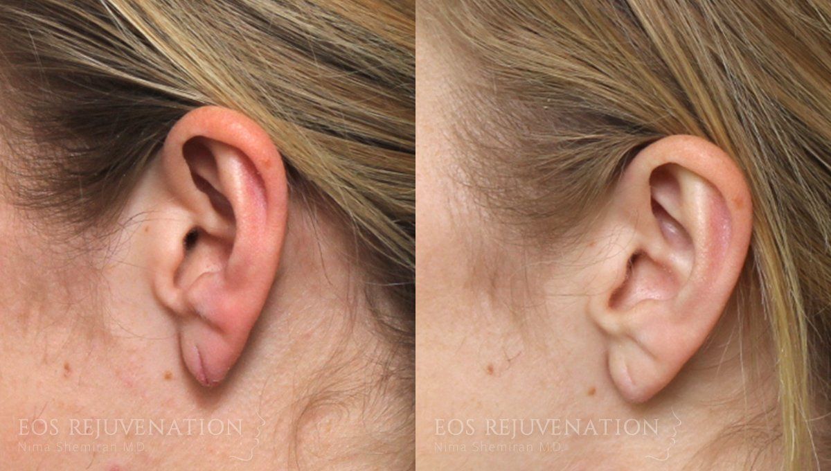 Earlobe Repair Before & After