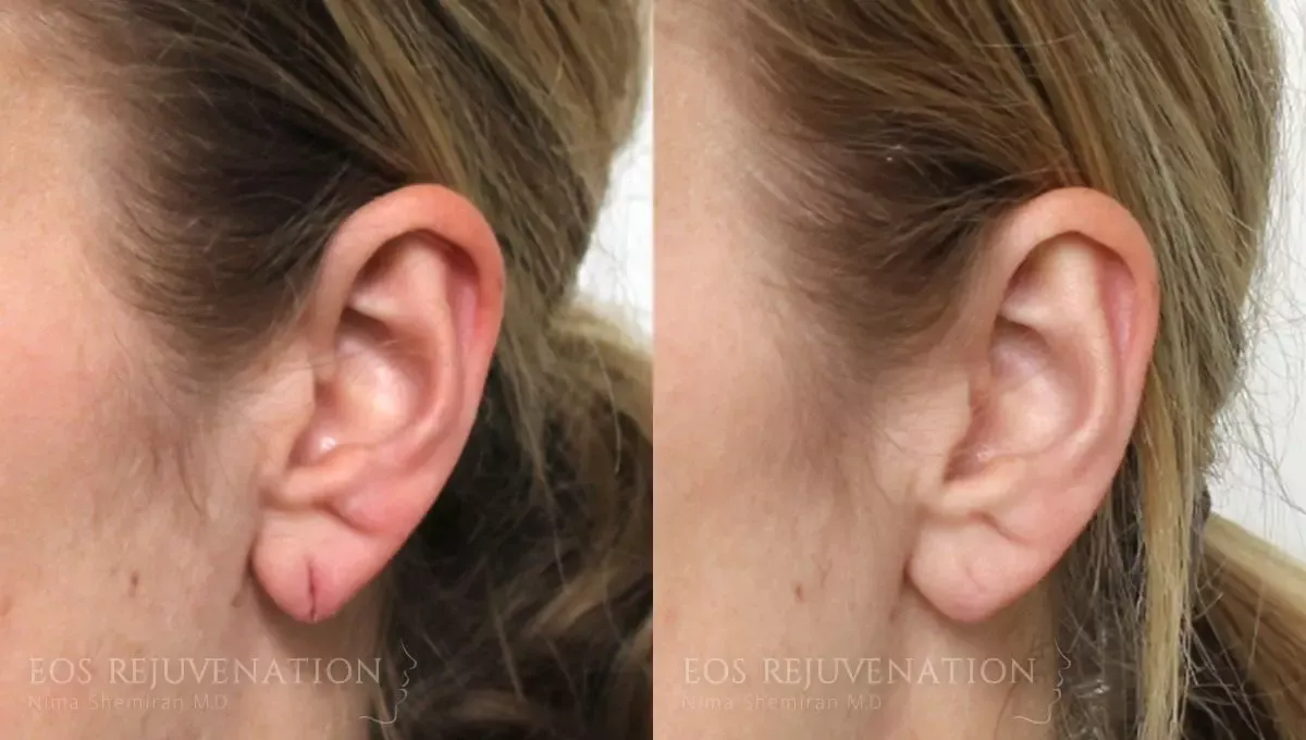 Earlobe Repair Before & After