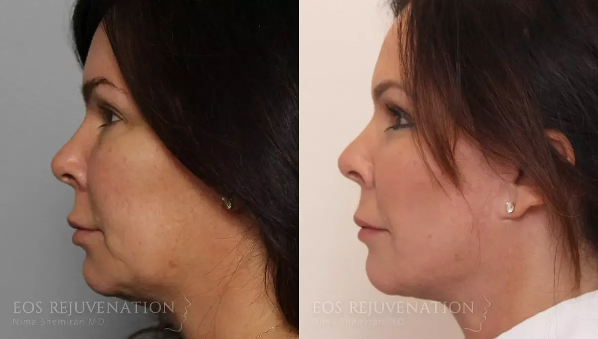 Buccal Fat Removal Before & After