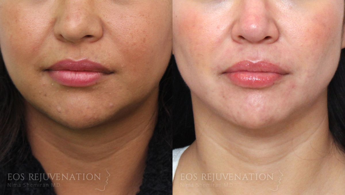 Buccal Fat Removal Before & After