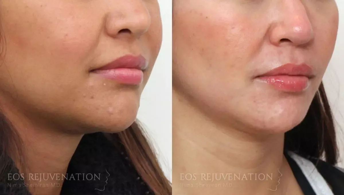 Buccal Fat Removal Before & After