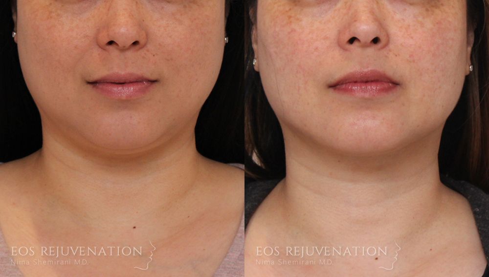 Buccal Fat Removal Before & After