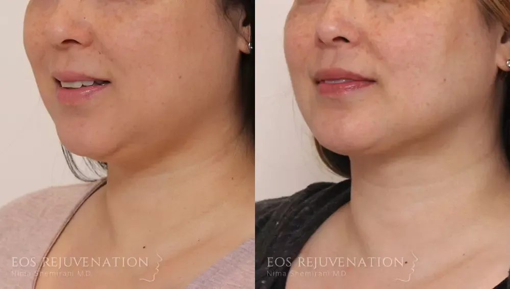 Buccal Fat Removal Before & After