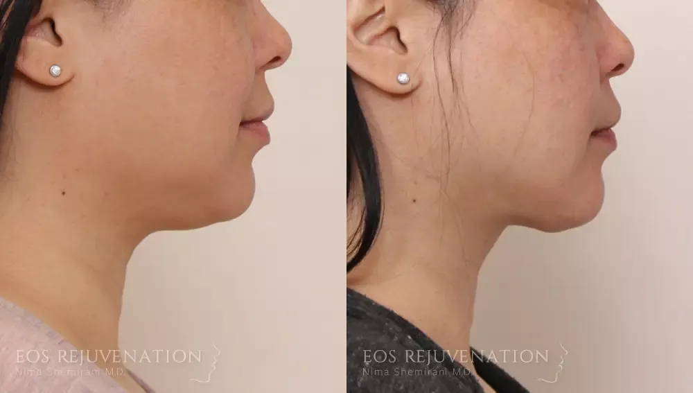 Buccal Fat Removal Before & After